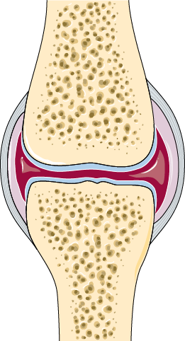 Arthritis