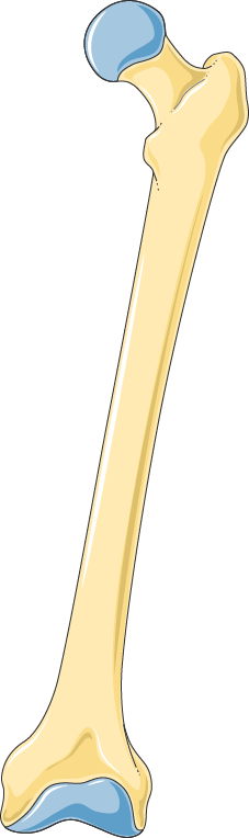 Avascular Necrosis of the Hip