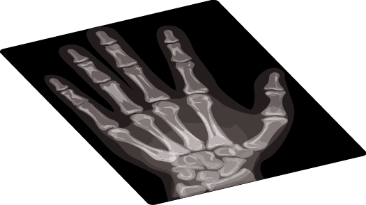 Carpal Tunnel Syndrome