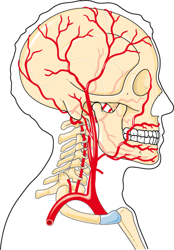 Cervicogenic Headache