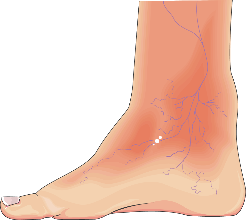 Diabetic Neuropathy
