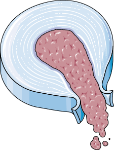 Discogenic Back Pain
