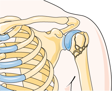 Frozen Shoulder