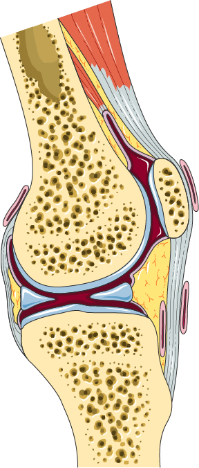 Knee Bursitis
