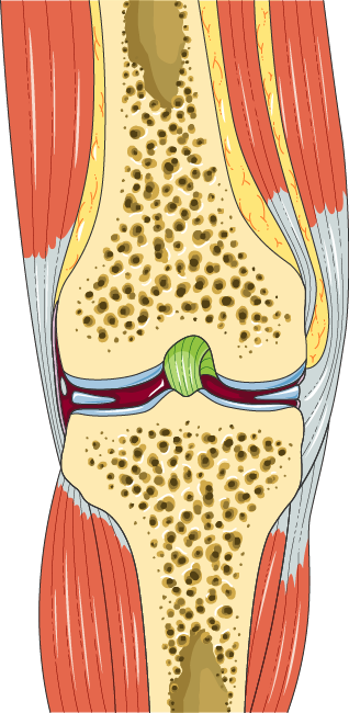 Knee Osteoarthritis