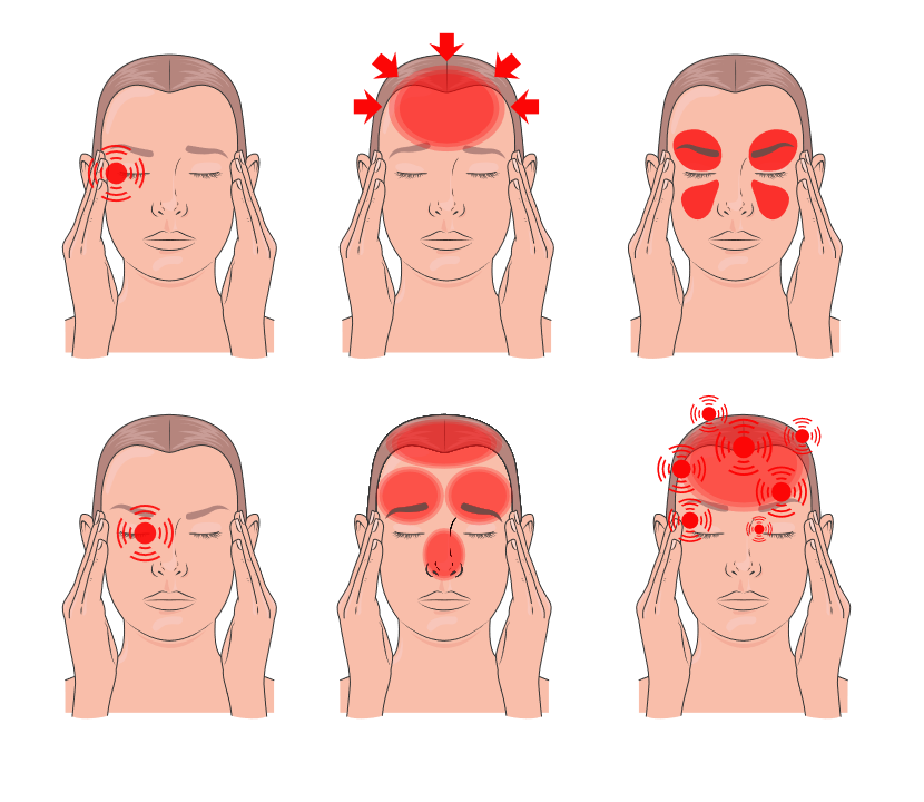 Migraine