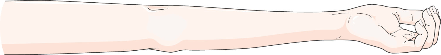 Phantom Limb Pain