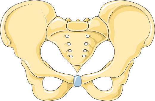 Piriformis Syndrome