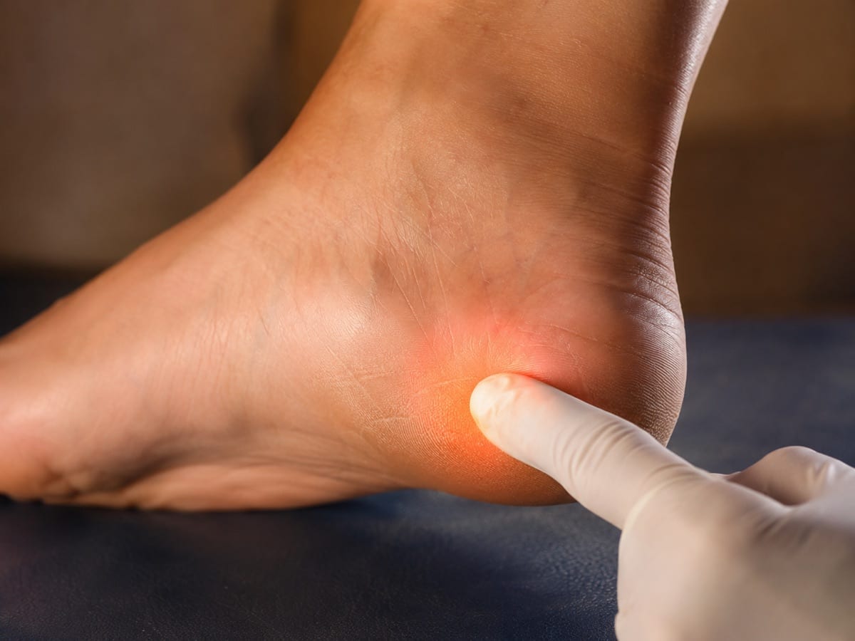 Close-up of a heel with the plantar fascia insertion highlighted at the tender point.