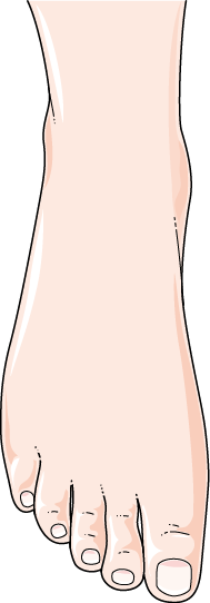 Plantar Fasciitis