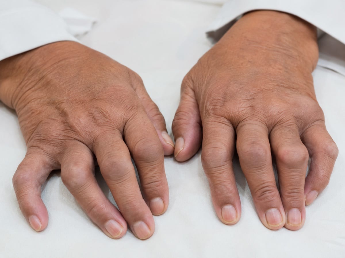 Hands with symmetric swollen knuckles and ulnar drift of rheumatoid arthritis.
