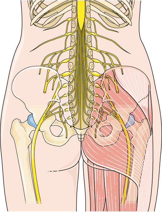 Sciatica