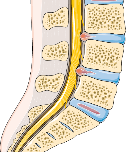 Slipped Disc