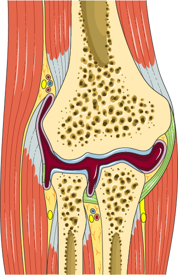 Tennis Elbow