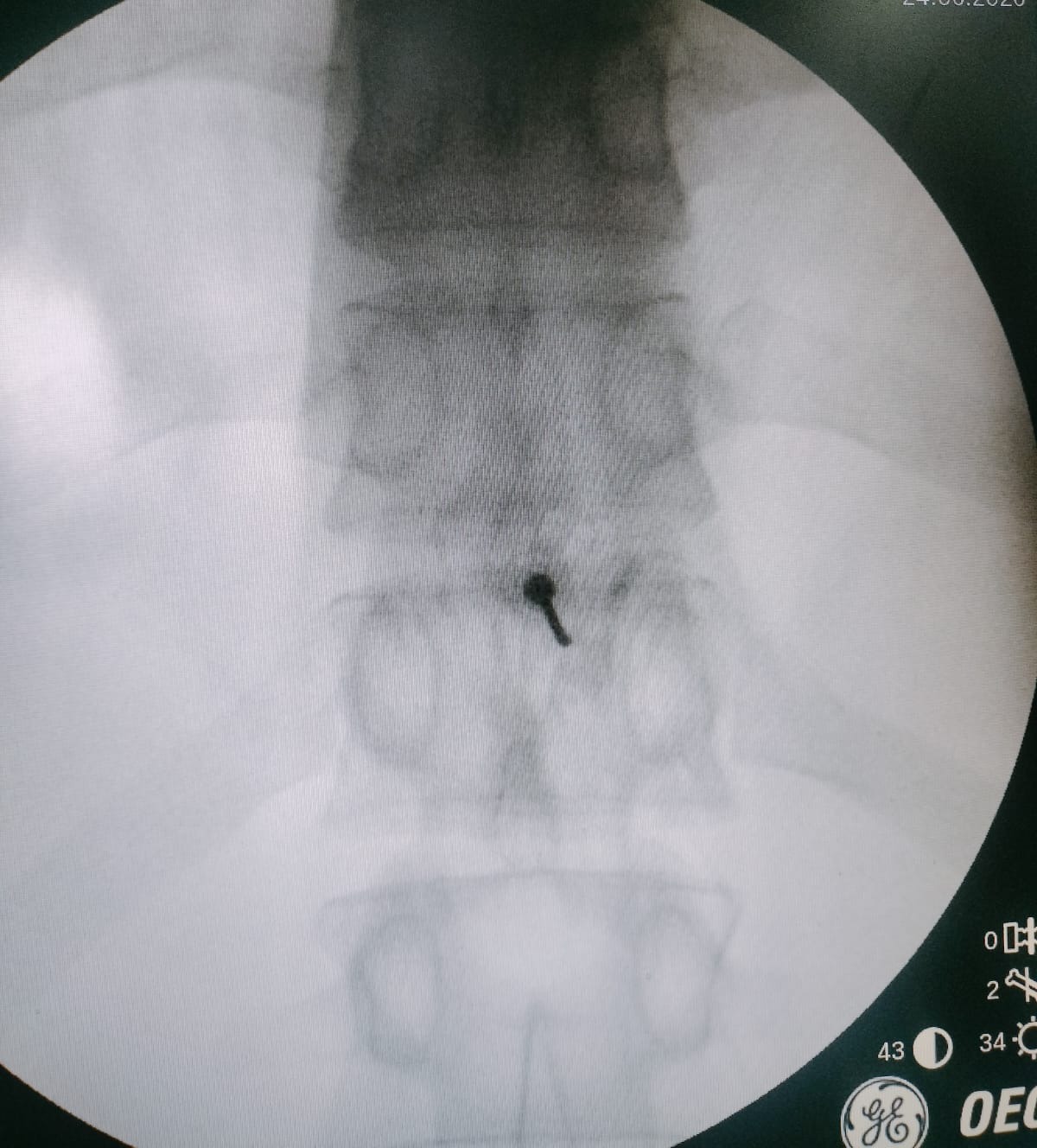 Steroid Injections